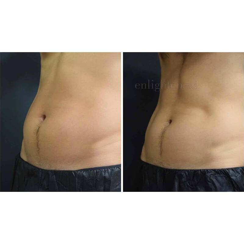 Coolsculpting abs before and after pictures