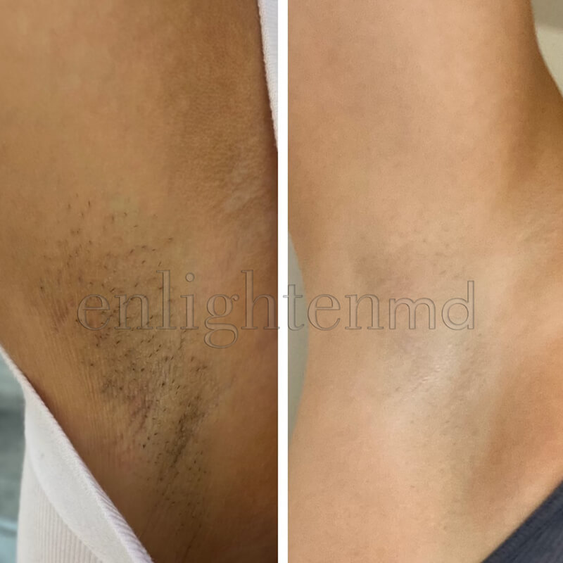 Laser Hair Removal before & after