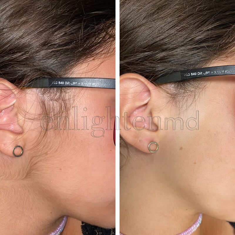 Laser Hair removal in Dallas, Texas