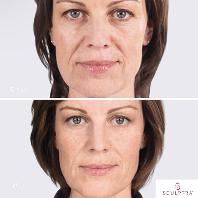 Sculptra med spa facial before and after