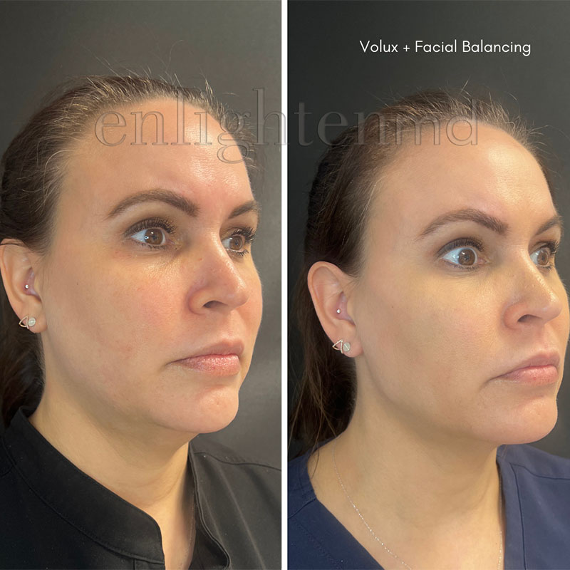 Volux med spa facial before and after