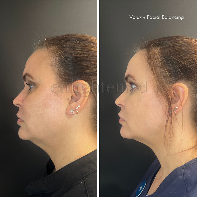 Volux med spa facial before and after