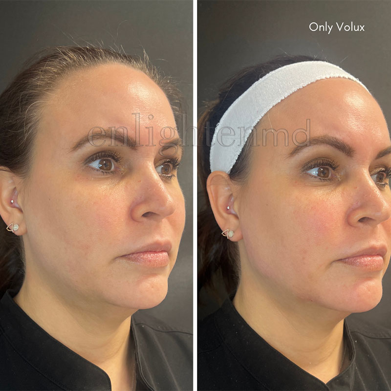 Volux med spa facial before and after
