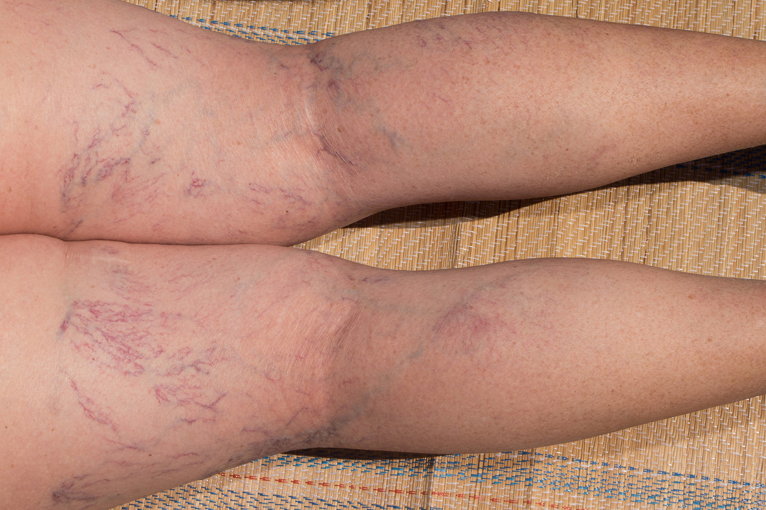 spider veins on a woman's legs