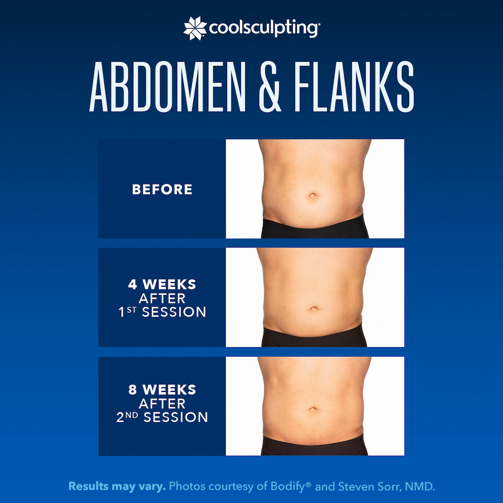 coolsculpting treatment infographic
