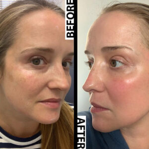 Fraxel laser before and after photos - Enlighten md Fraxel laser before and after photos